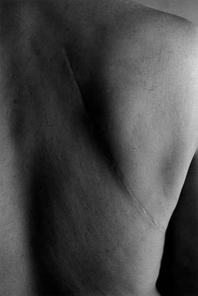 石内都《Scars#26 illness 1961》1999 東京国立近代美術館蔵 Ishiuchi Miyako